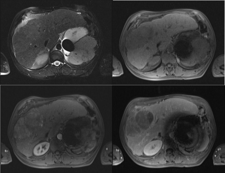 hcc-example-mri-nucsradiology