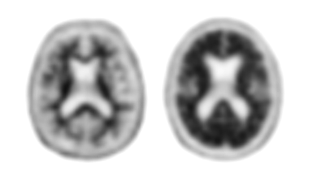 pet ct brain amyloid imaging